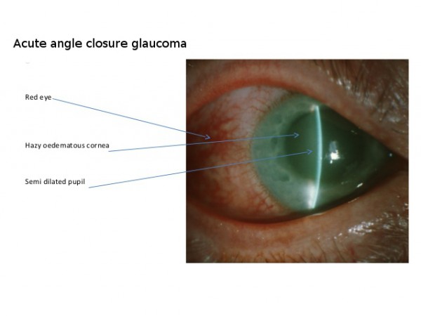 glaucoma-rcsi-24-638.jpg