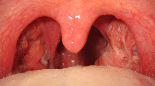 Tonsilitis.jpg