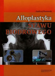 alloplastyka-stawu-biodrowego.jpg